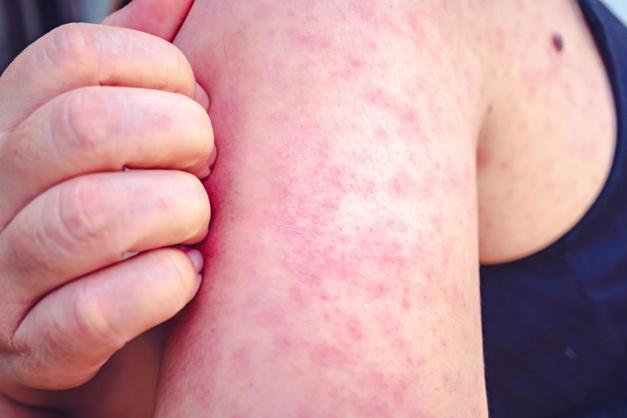 North Dakota Sees Rise in Measles Cases, Totaling 28