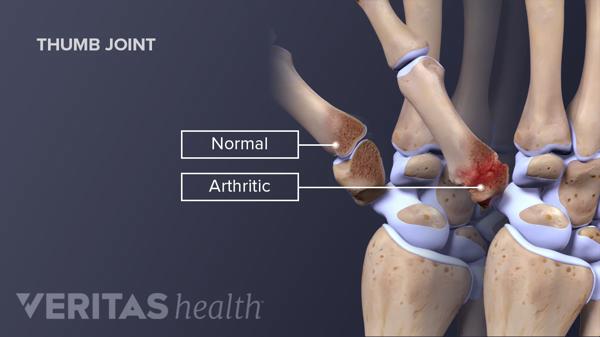 Can Cracking Your Knuckles Cause Arthritis?