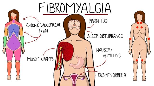Understanding Chronic Pain: Is It Fibromyalgia?