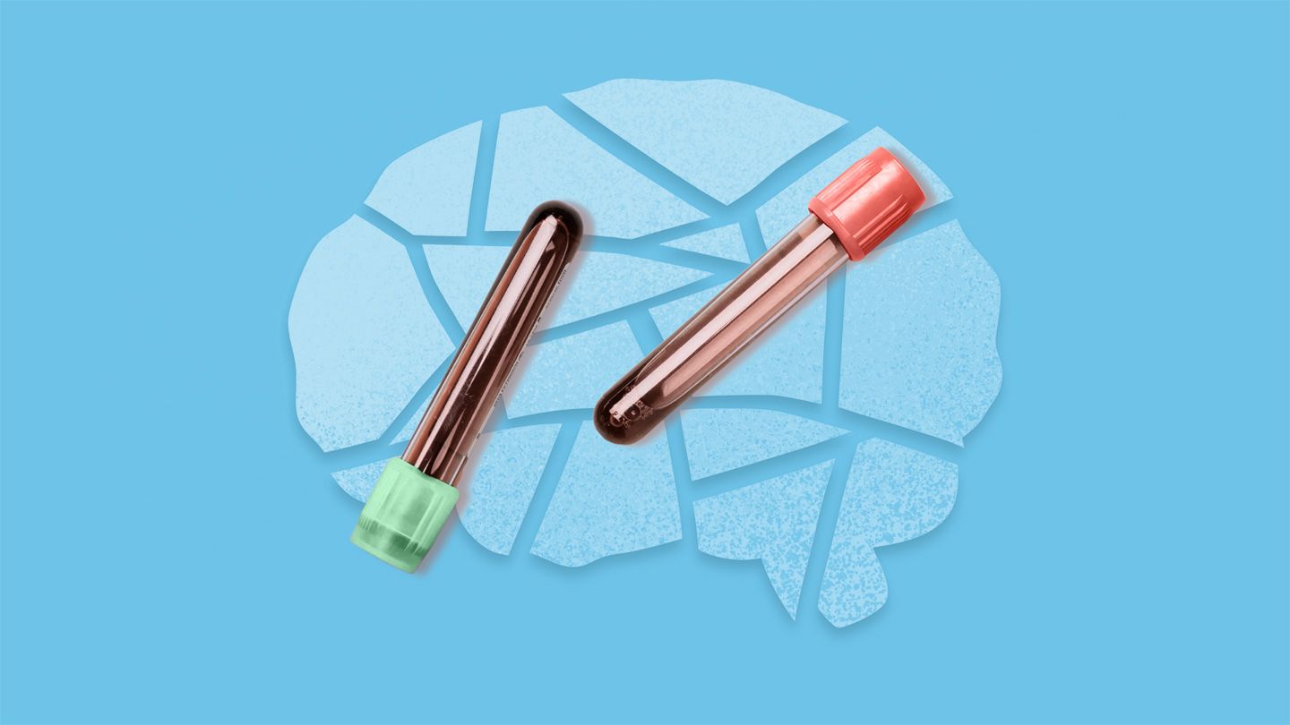 Revolutionary Blood Test Receives FDA Approval for Alzheimer’s Diagnosis