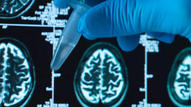Alzheimer Tedavisinde Umut Veren Yenilikler ve Önleme Stratejileri